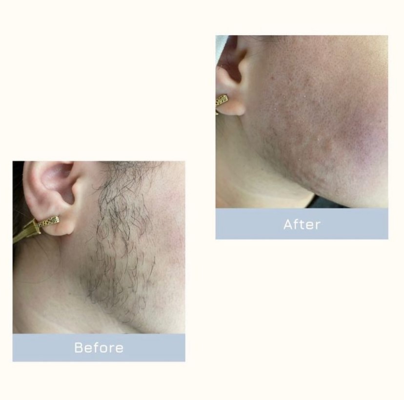 Laser and Spa - Laser Depilation - Фото 4