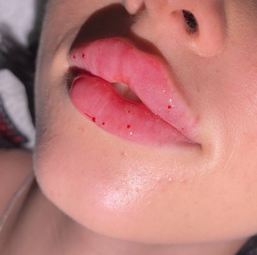 4 FACE Aesthetics - All Types of Injection Procedures - Фото 6