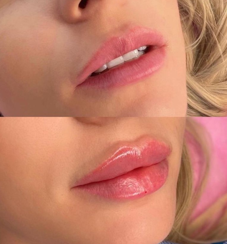 4 FACE Aesthetics - All Types of Injection Procedures - Фото 4