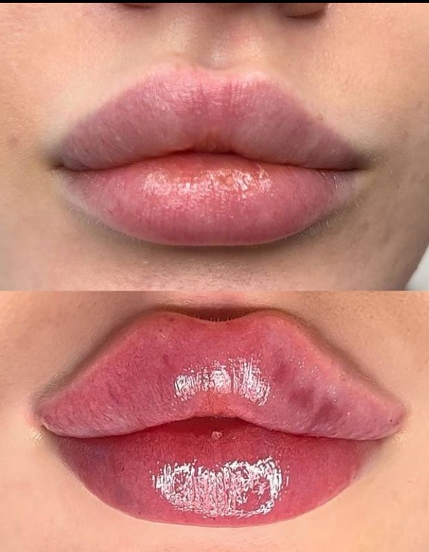 4 FACE Aesthetics - All Types of Injection Procedures - Фото 2