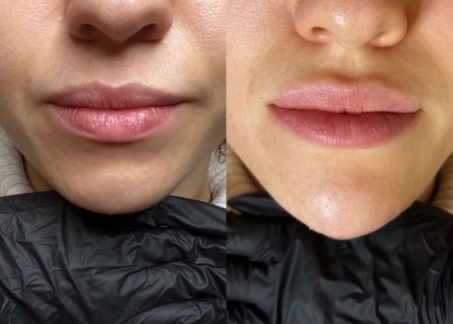 4 FACE Aesthetics - All Types of Injection Procedures - Фото 5