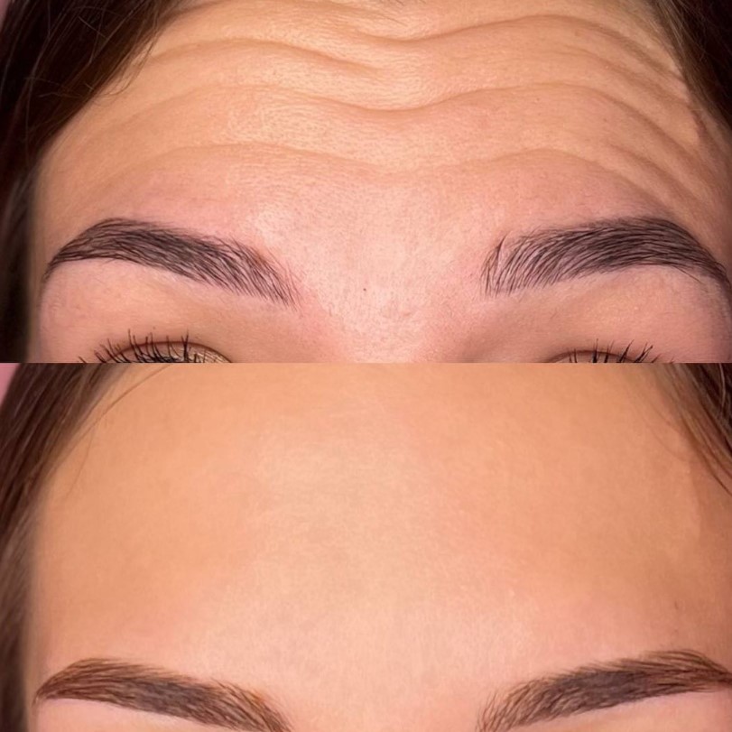 4 FACE Aesthetics - All Types of Injection Procedures - Фото 3