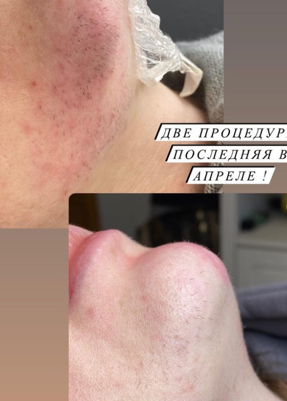 Екатерина - Электроэпиляция Лос-Анджелес - Фото 3
