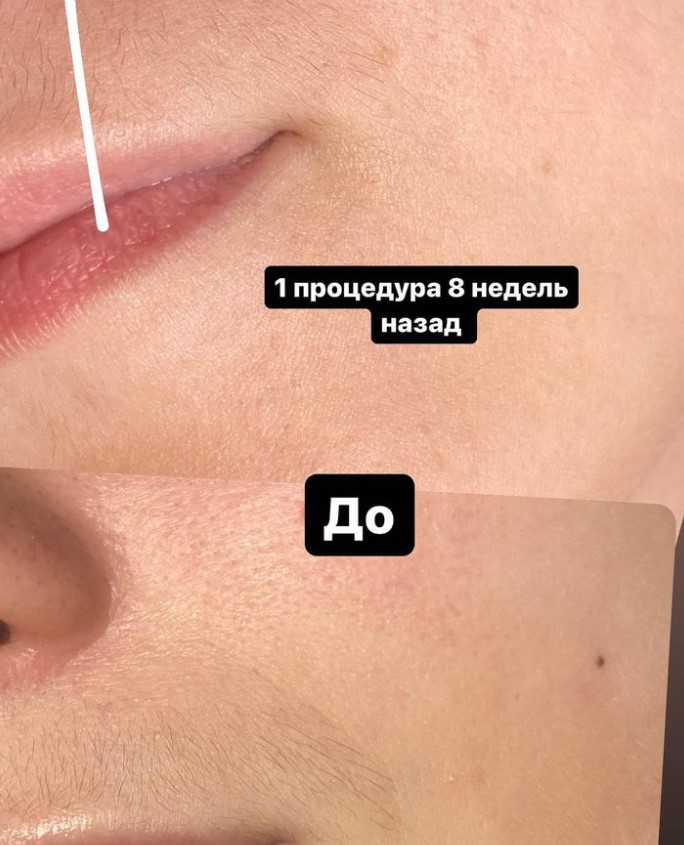 Екатерина - Электроэпиляция Лос-Анджелес - Фото 6