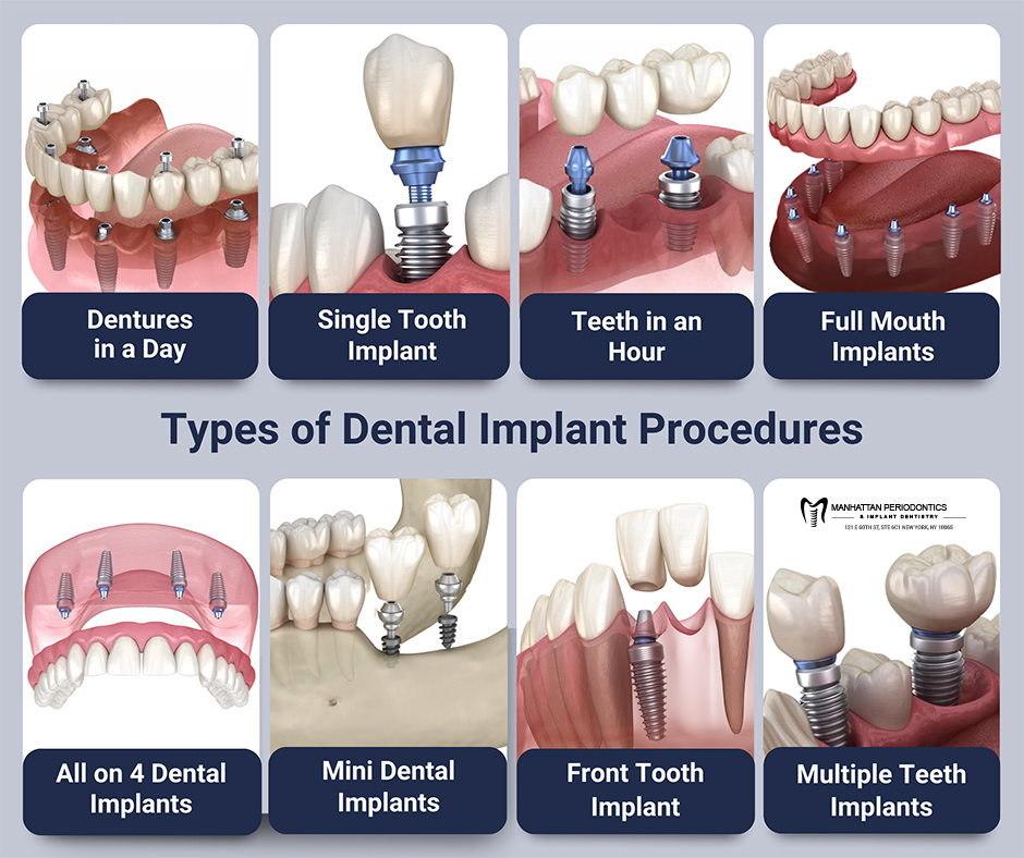 Manhattan Periodontics - Implant Dentistry - Фото 9