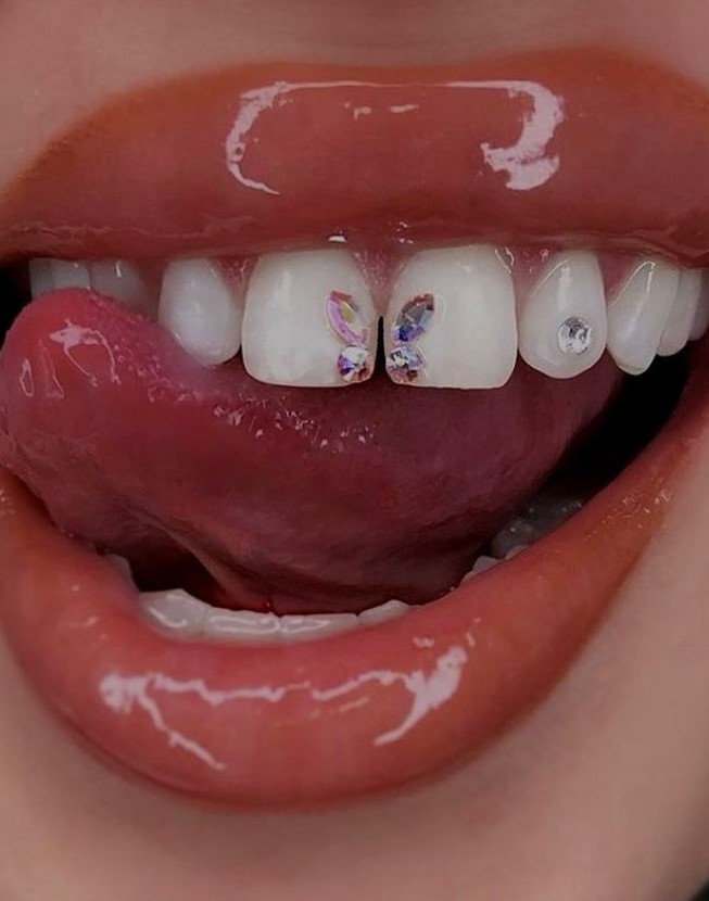 Tooth Gems - Фото 3