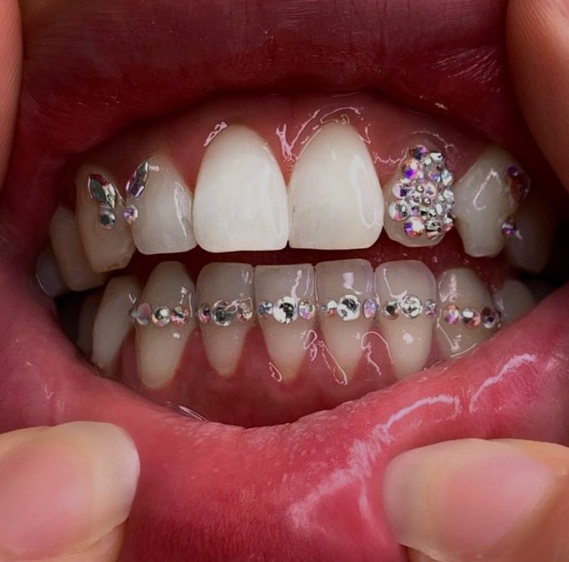 Tooth Gems - Фото 4