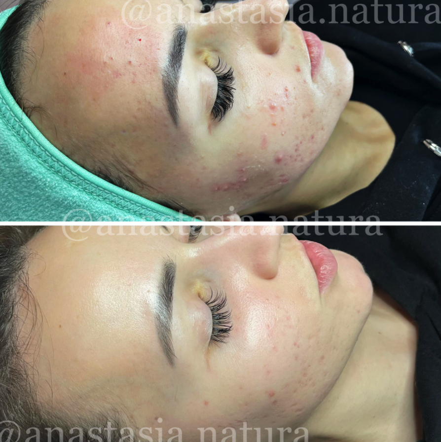 Esthetician Acne Сontrol Specialist NYC - Фото 4