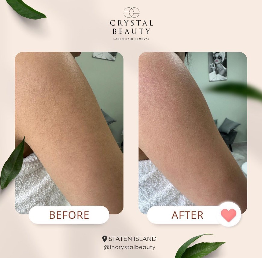 Laser Hair Removal | Staten Island - Фото 3