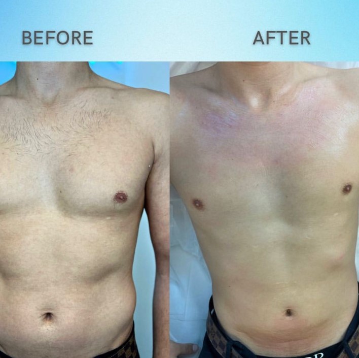 Laser Hair Removal - Фото 3