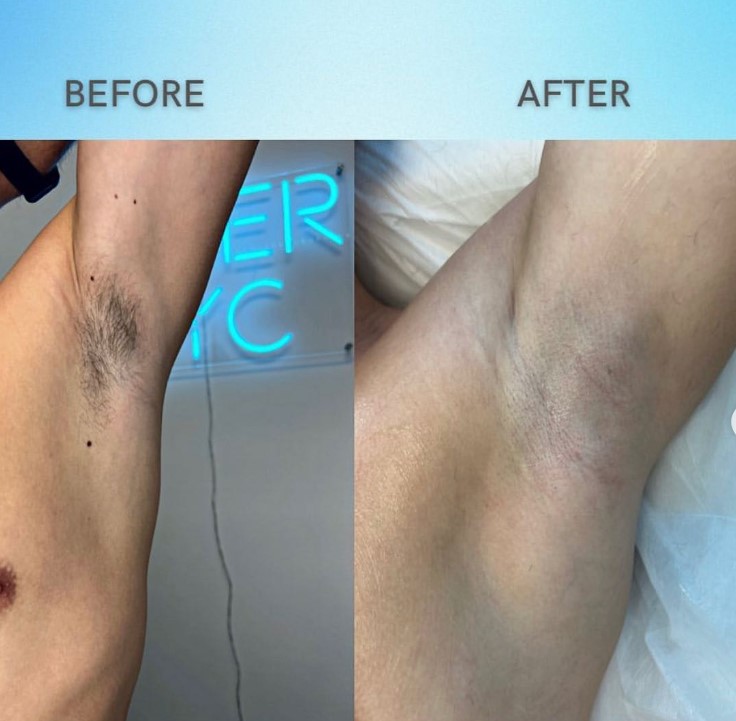 Laser Hair Removal - Фото 4