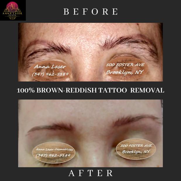 Anna Laser Cosmetology - салон лазерного удаления волос в Бруклине - Фото 2