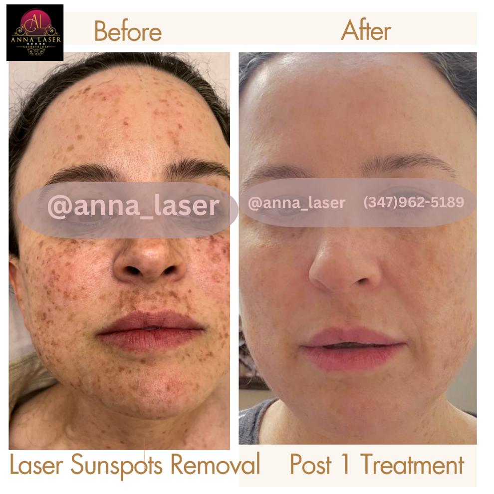 Anna Laser Cosmetology - салон лазерного удаления волос в Бруклине - Фото 7
