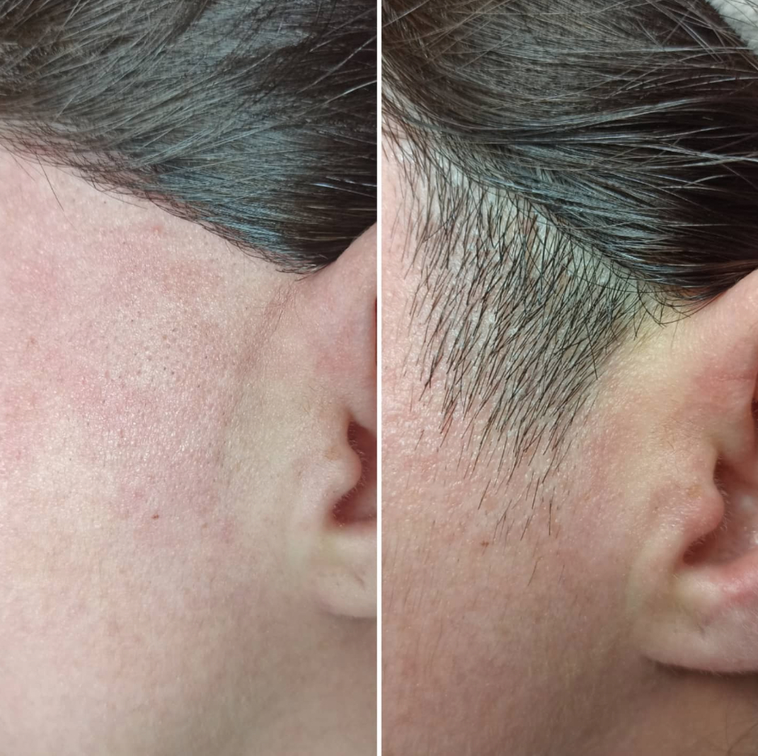 Татьяна, Электроэпиляция на Аппарате Apilus - Фото 4