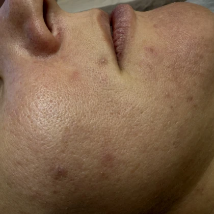 photo-chistka-litsa-dlya-m-i-zh