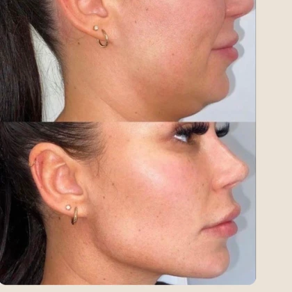 aesthetic-injections-botox-fil-photo